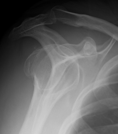 Displaced Greater Tuberosity Fracture Lateral